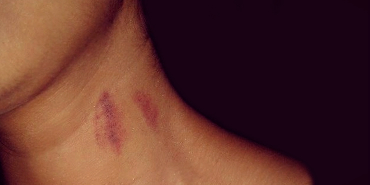 ¡Gustos que dan susto! Adolescente muere por chupón de su novia