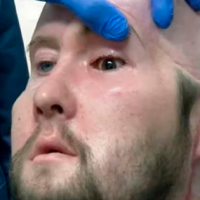 Primer trasplante ocular completo