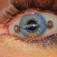 Impactante Historia de la joven con un piercing en su ojo izquierdo