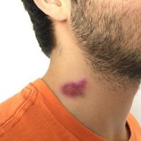 "Chupón" en el cuello le habría provocado la muerte a un joven de 17 años