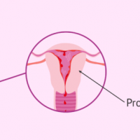 Dolores menstruales podrían ser peores que un ataque al corazón