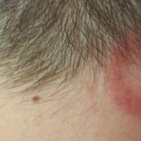 Aumentan casos de tiña del cuero cabelludo vinculados a barberías