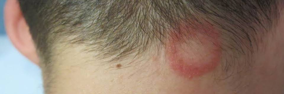 Aumentan casos de tiña del cuero cabelludo vinculados a barberías