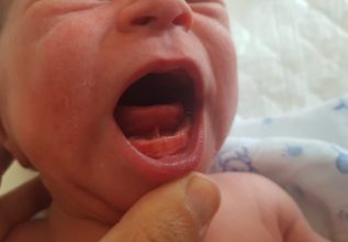 Una práctica que ha generado polémicas: Médicos alertan sobre el peligro de cortarle el frenillo a los bebés