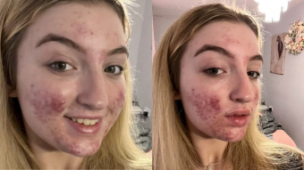 "No significa que no seas hermosa": joven influencer critica a Tik Tok por bajarle la cuenta debido a su acné