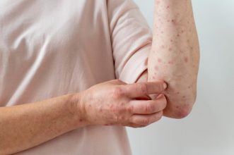Récord de sífilis en Chile: Se duplican los casos entre mujeres mayores de 60